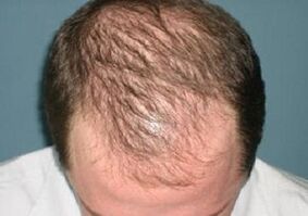 ilea galtzearen arrazoiak