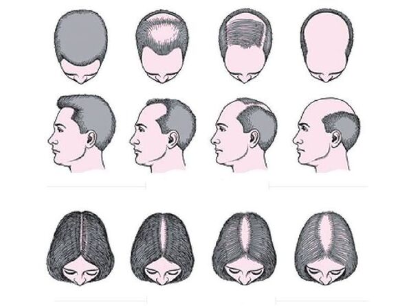 Alopezia androgenetikoa gizon eta emakumeengan