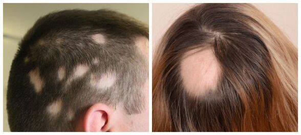 Alopezia areata