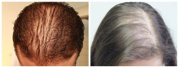 Alopezia difusa