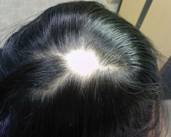 Alopecia areata edo alopecia areata emakumeengan