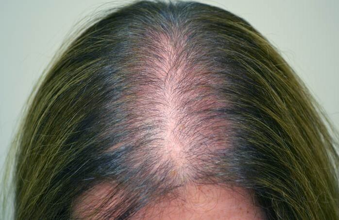 Alopezia (burusoiltasuna) emakumeengan