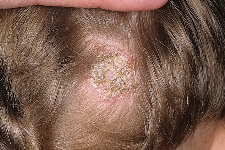 Emakumeen alopezia mota seborreikoa