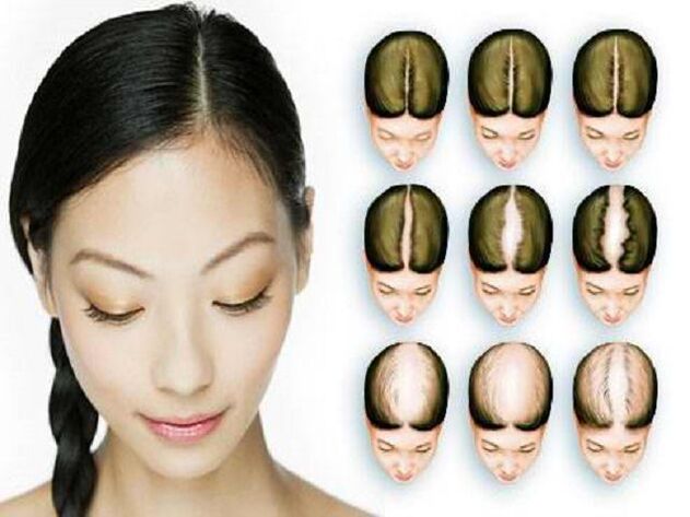 Emakumeen alopeziaren faseak