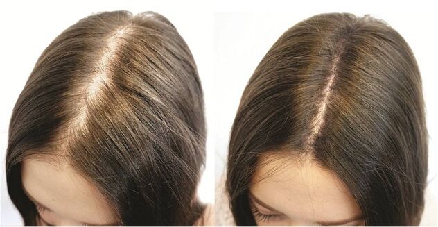 Emakumeen alopeziaren tratamendu puntualaren emaitza