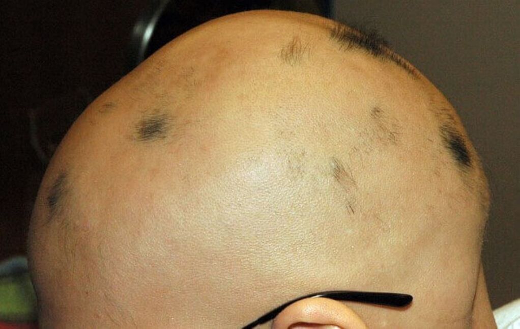 Buruko buruko alopezia osoa gizon batean