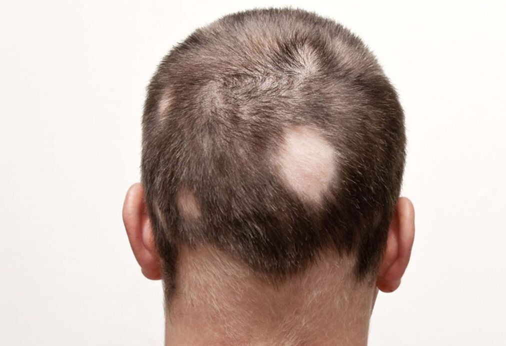 buruko habia (fokua) alopezia