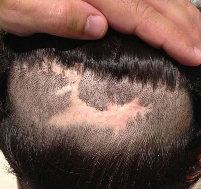 larruazaleko alopezia zikatriziala