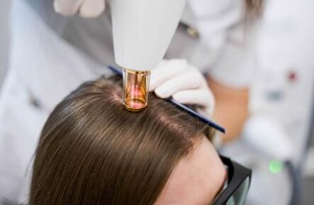 Alopezia androgenetikorako laser terapia