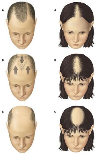Alopezia androgenikoa gizon eta emakumeengan