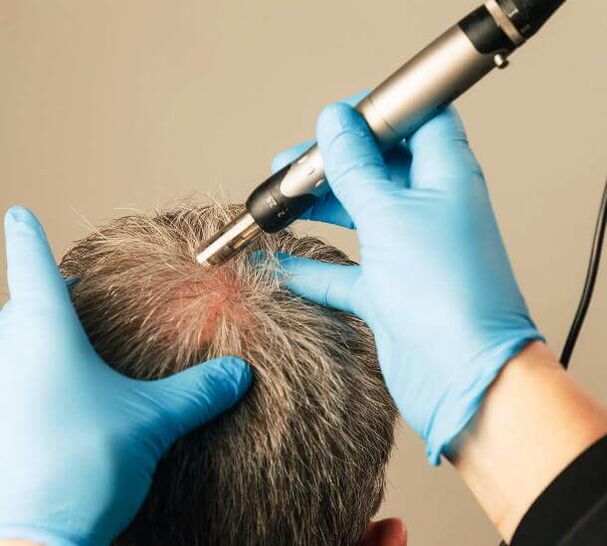 Alopezia androgenikoaren tratamendurako fisioterapia