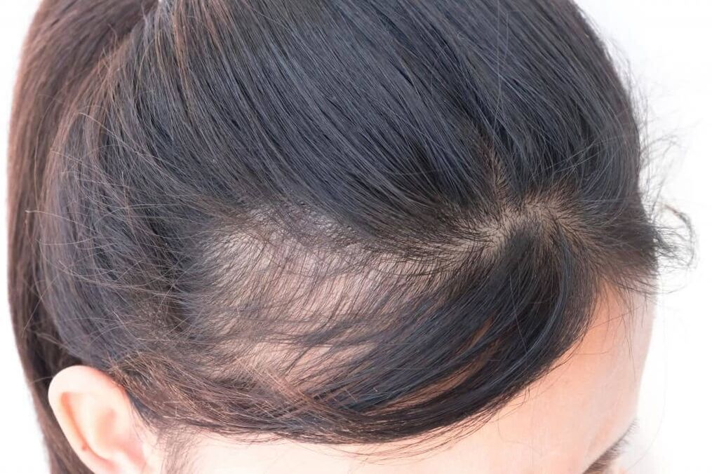 Emakumeen alopezia androgenikoa