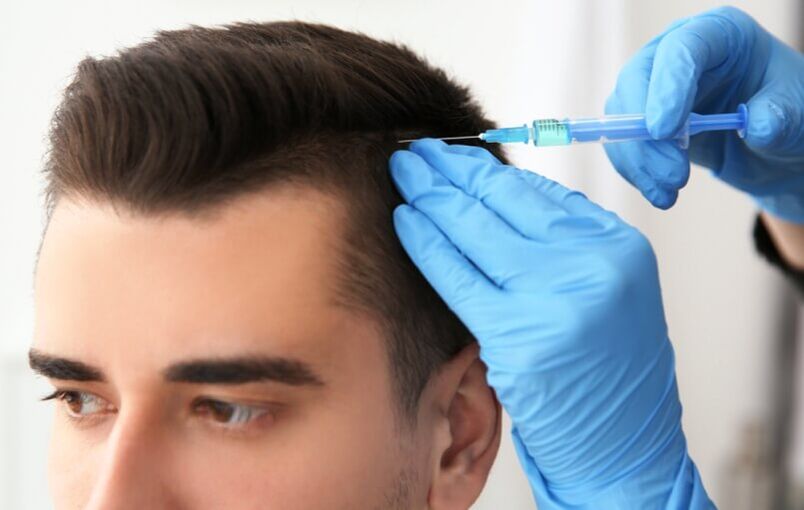 Mesoterapia alopezia androgenikoan ilearen hazkuntza suspertzeko